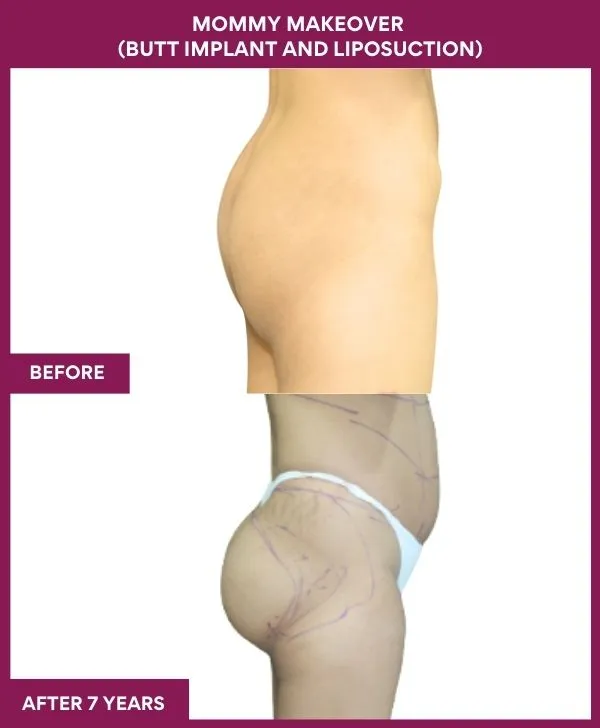 mommy-makeover-buttock-implants-before-after-results-mumbai-india-patient01-side-right