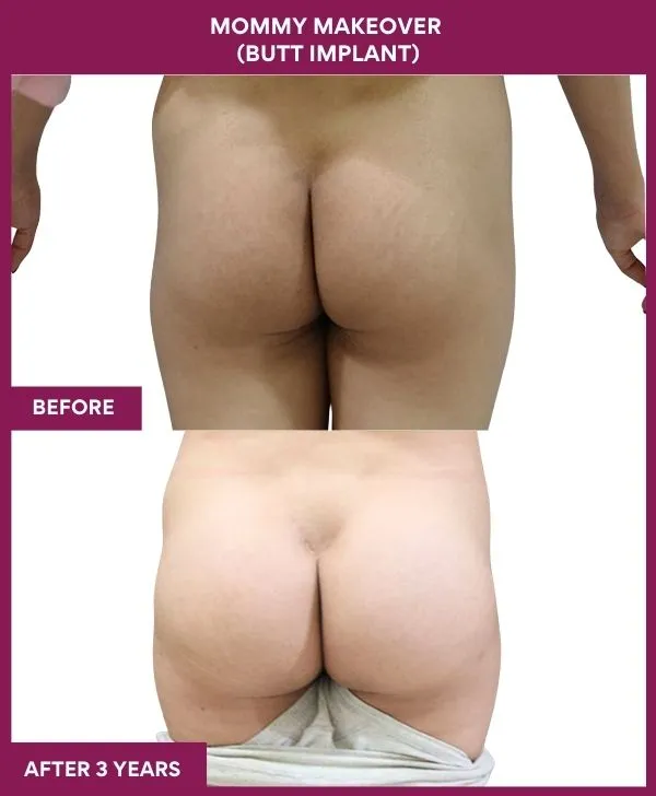 mommy-makeover-buttock-implants-before-after-results-mumbai-india-patient02-back
