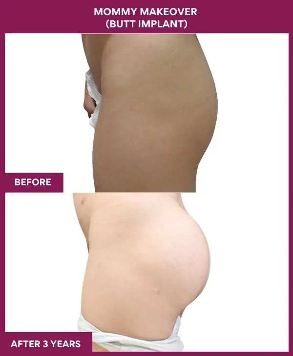 mommy-makeover-buttock-implants-before-after-results-mumbai-india-patient02-side-left