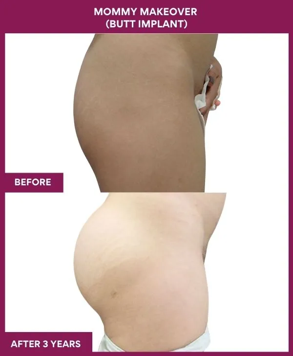 mommy-makeover-buttock-implants-before-after-results-mumbai-india-patient02-side-right
