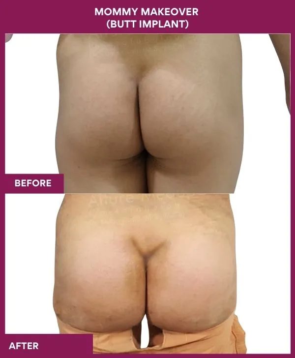 mommy-makeover-buttock-implants-before-after-results-mumbai-india-patient04-back