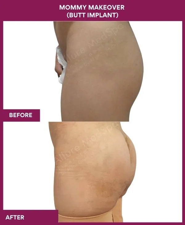 mommy-makeover-buttock-implants-before-after-results-mumbai-india-patient04-side-left