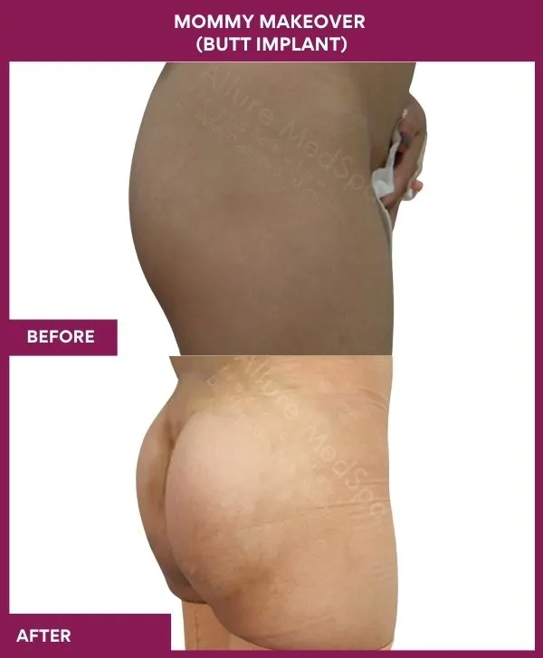 mommy-makeover-buttock-implants-before-after-results-mumbai-india-patient04-side-right