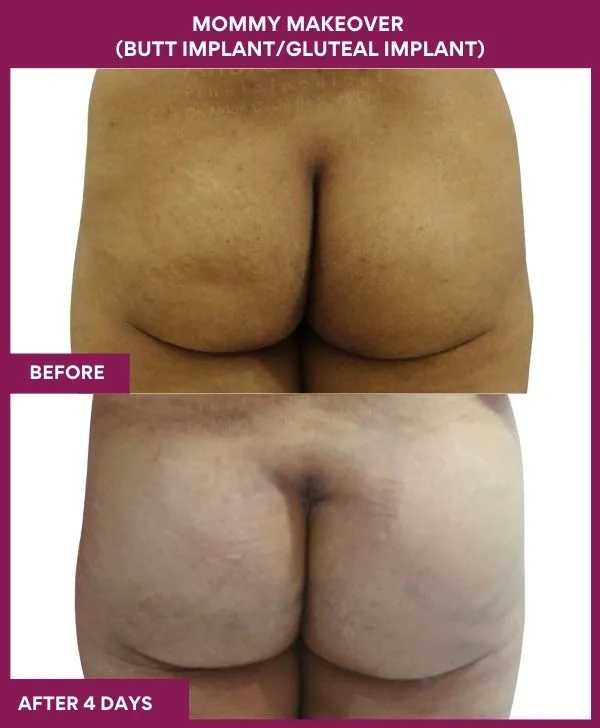 mommy-makeover-buttock-implants-before-after-results-mumbai-india-patient05-back