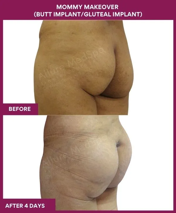 mommy-makeover-buttock-implants-before-after-results-mumbai-india-patient05-side-left