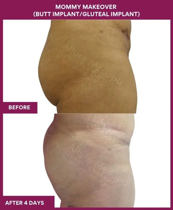mommy-makeover-buttock-implants-before-after-results-mumbai-india-patient05-side-right