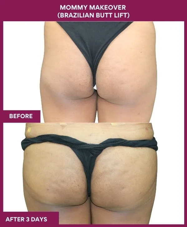 mommy-makeover-buttock-implants-before-after-results-mumbai-india-patient06-back