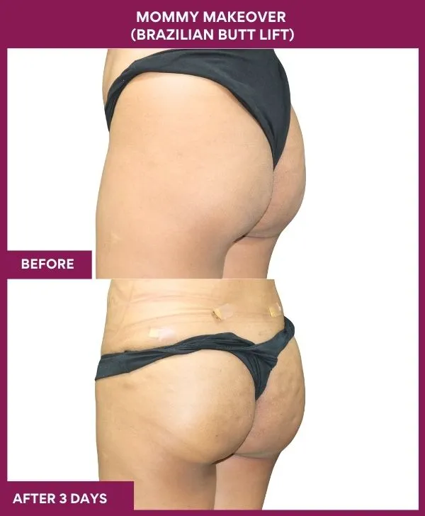 mommy-makeover-buttock-implants-before-after-results-mumbai-india-patient06-side-left