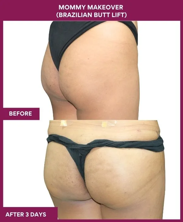 mommy-makeover-buttock-implants-before-after-results-mumbai-india-patient06-side-right