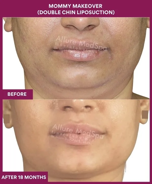 mommy-makeover-double-chin-liposuction-before-after-results-mumbai-india-patient02-front