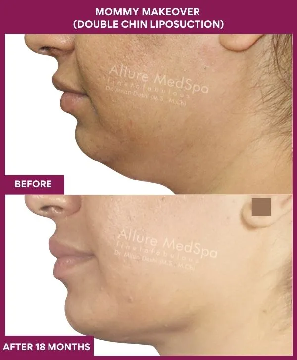 mommy-makeover-double-chin-liposuction-before-after-results-mumbai-india-patient02-side-left