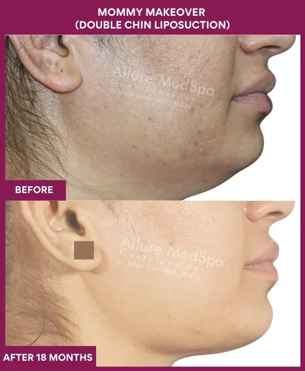 mommy-makeover-double-chin-liposuction-before-after-results-mumbai-india-patient02-side-right