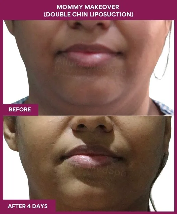 mommy-makeover-double-chin-liposuction-before-after-results-mumbai-india-patient03-front