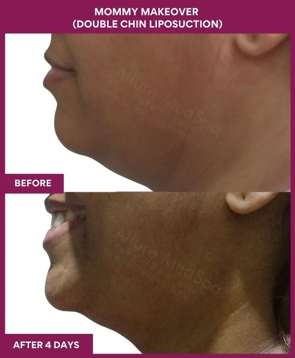 mommy-makeover-double-chin-liposuction-before-after-results-mumbai-india-patient03-side-left