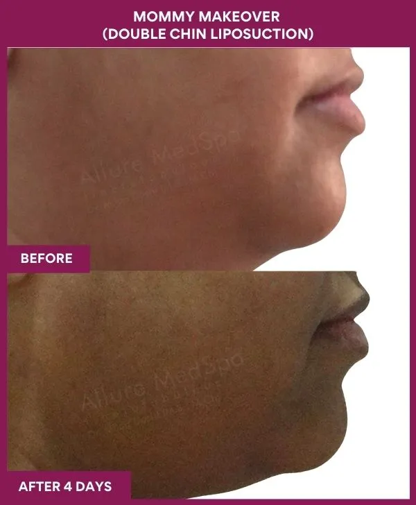 mommy-makeover-double-chin-liposuction-before-after-results-mumbai-india-patient03-side-right