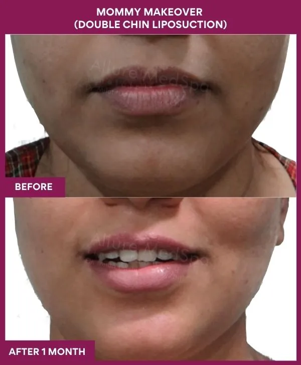 mommy-makeover-double-chin-liposuction-before-after-results-mumbai-india-patient04-front