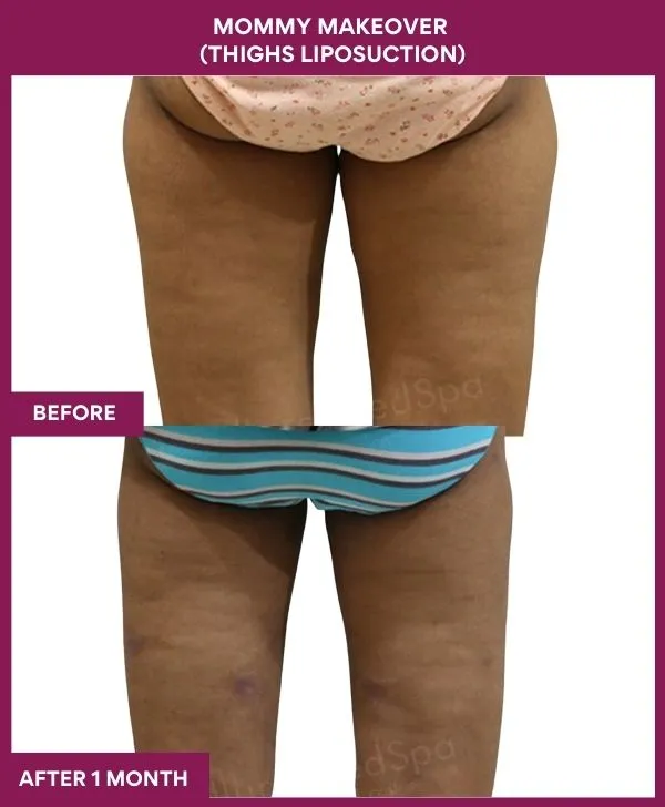 mommy-makeover-thigh-liposuction-before-after-results-mumbai-india-patient01-back