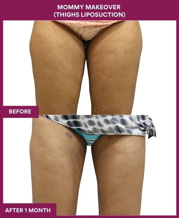 mommy-makeover-thigh-liposuction-before-after-results-mumbai-india-patient01-front