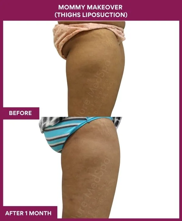 mommy-makeover-thigh-liposuction-before-after-results-mumbai-india-patient01-side-left