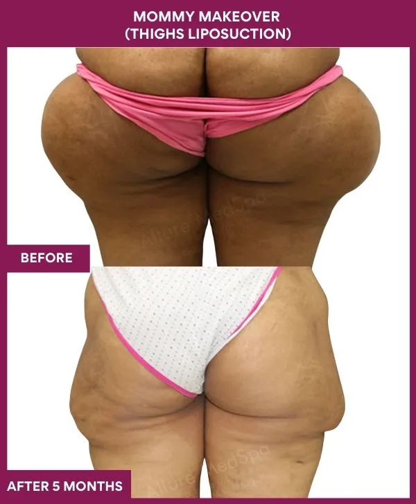mommy-makeover-thigh-liposuction-before-after-results-mumbai-india-patient03-back