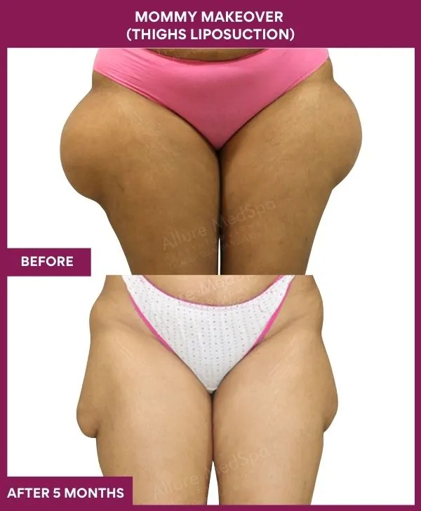 mommy-makeover-thigh-liposuction-before-after-results-mumbai-india-patient03-front