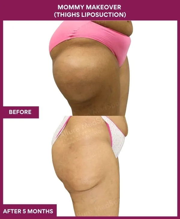 mommy-makeover-thigh-liposuction-before-after-results-mumbai-india-patient03-side-right