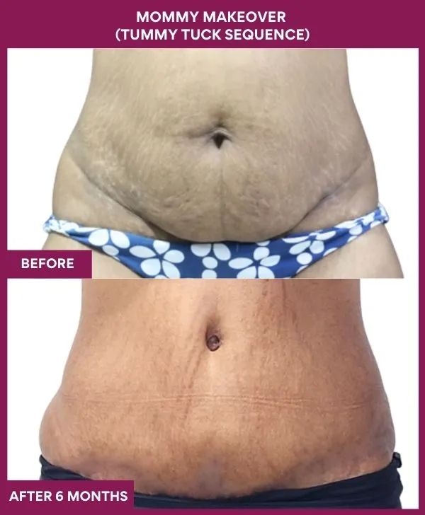 mommy-makeover-tummy-tuck-before-after-results-mumbai-india-patient01-front