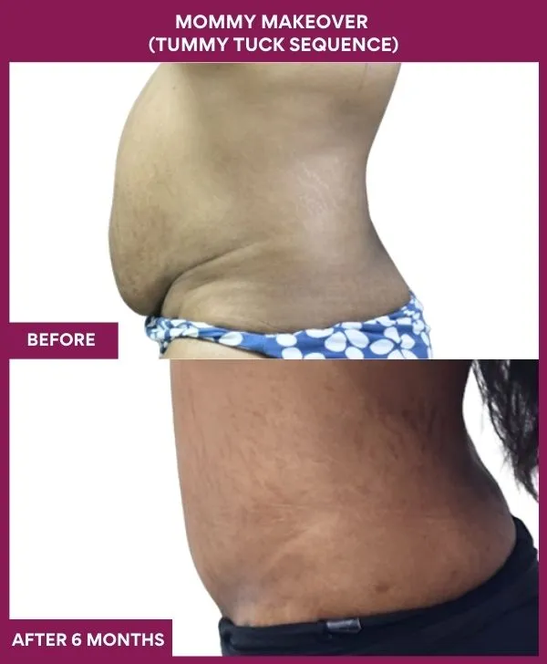 mommy-makeover-tummy-tuck-before-after-results-mumbai-india-patient01-side-left