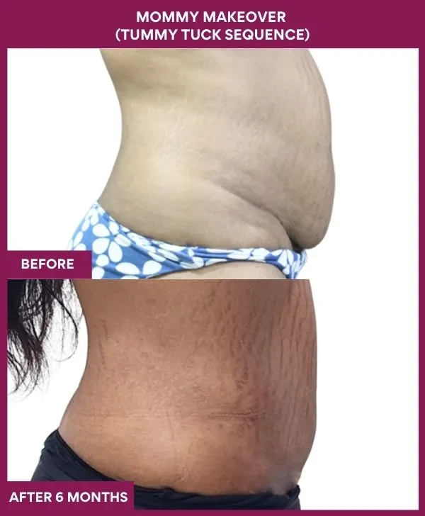 mommy-makeover-tummy-tuck-before-after-results-mumbai-india-patient01-side-right