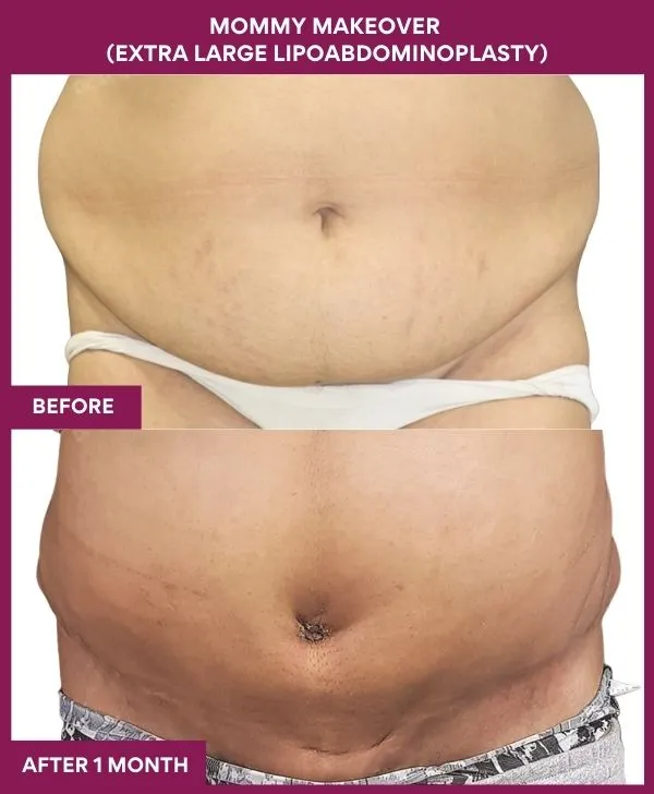 mommy-makeover-tummy-tuck-before-after-results-mumbai-india-patient02-front