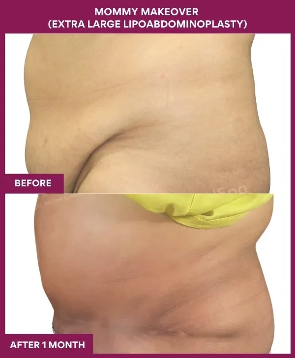 mommy-makeover-tummy-tuck-before-after-results-mumbai-india-patient02-side-left