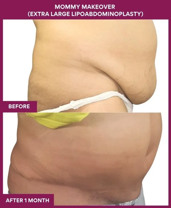 mommy-makeover-tummy-tuck-before-after-results-mumbai-india-patient02-side-right