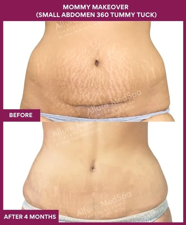 mommy-makeover-tummy-tuck-before-after-results-mumbai-india-patient03-front