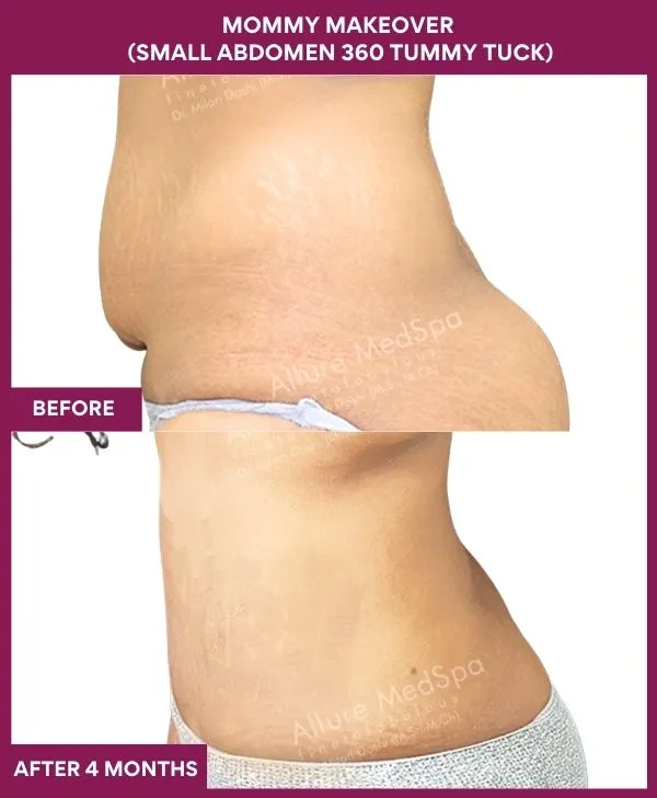 mommy-makeover-tummy-tuck-before-after-results-mumbai-india-patient03-side-left