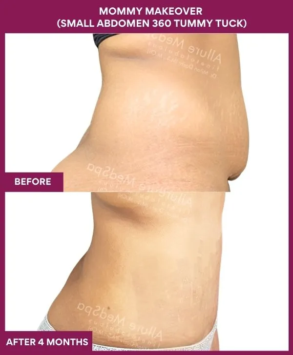 mommy-makeover-tummy-tuck-before-after-results-mumbai-india-patient03-side-right