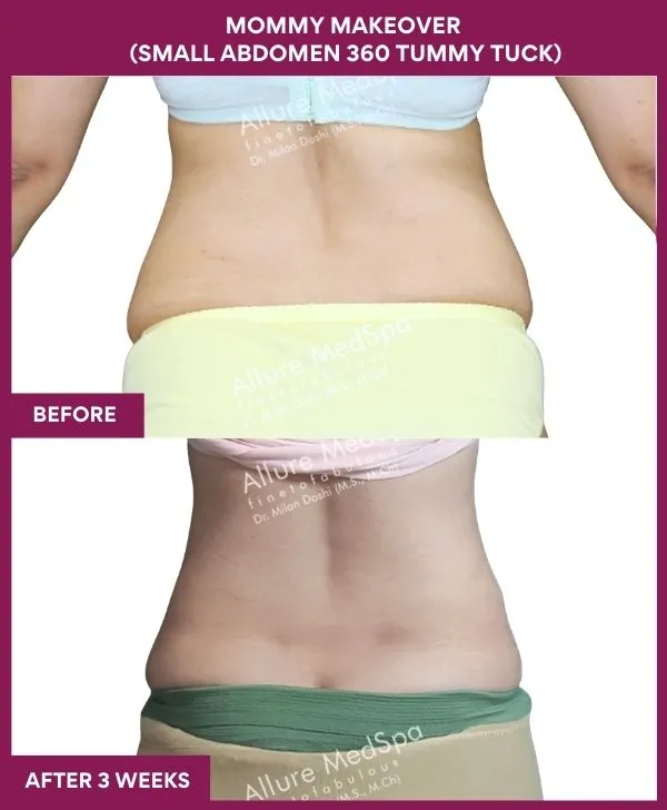 mommy-makeover-tummy-tuck-before-after-results-mumbai-india-patient04-back