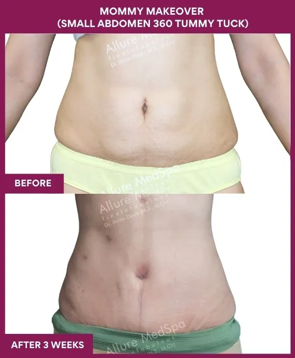 mommy-makeover-tummy-tuck-before-after-results-mumbai-india-patient04-front