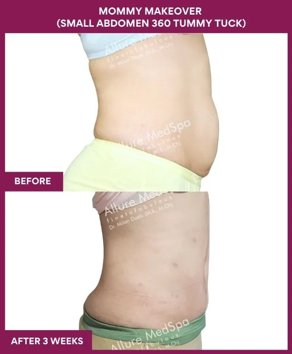 mommy-makeover-tummy-tuck-before-after-results-mumbai-india-patient04-side-right