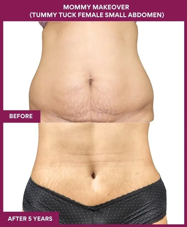 mommy-makeover-tummy-tuck-before-after-results-mumbai-india-patient05-front