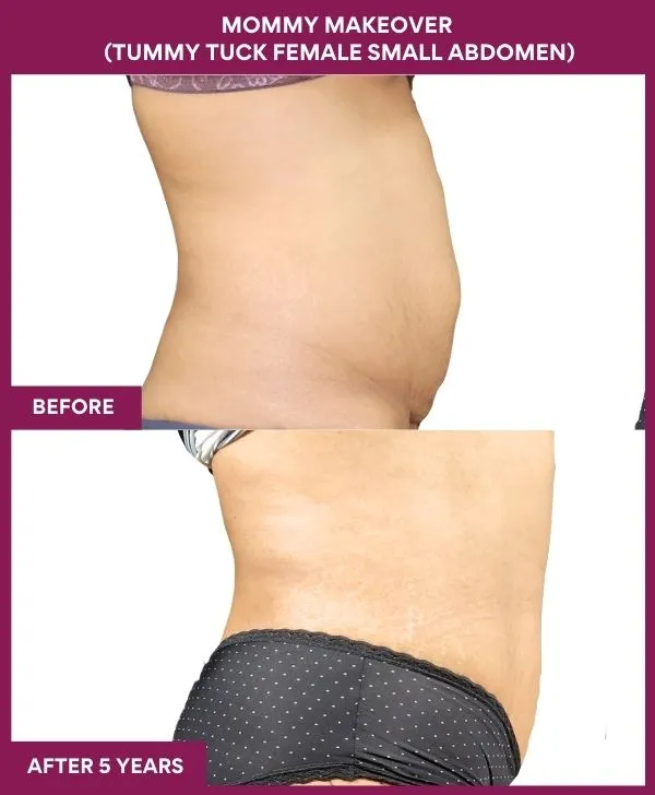 mommy-makeover-tummy-tuck-before-after-results-mumbai-india-patient05-side-right