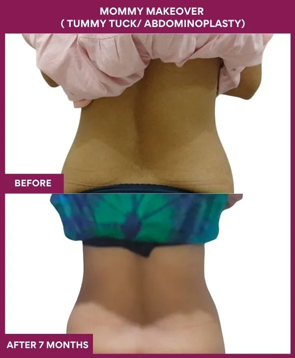 mommy-makeover-tummy-tuck-before-after-results-mumbai-india-patient06-back