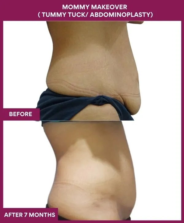 mommy-makeover-tummy-tuck-before-after-results-mumbai-india-patient06-side-right
