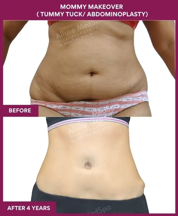 mommy-makeover-tummy-tuck-before-after-results-mumbai-india-patient07-front