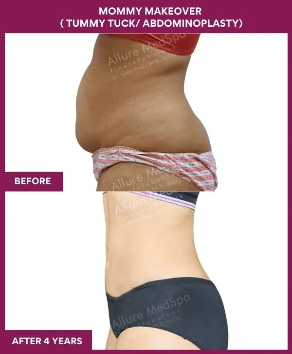 mommy-makeover-tummy-tuck-before-after-results-mumbai-india-patient07-side-left