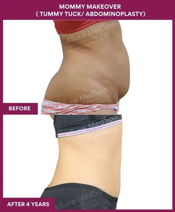 mommy-makeover-tummy-tuck-before-after-results-mumbai-india-patient07-side-right
