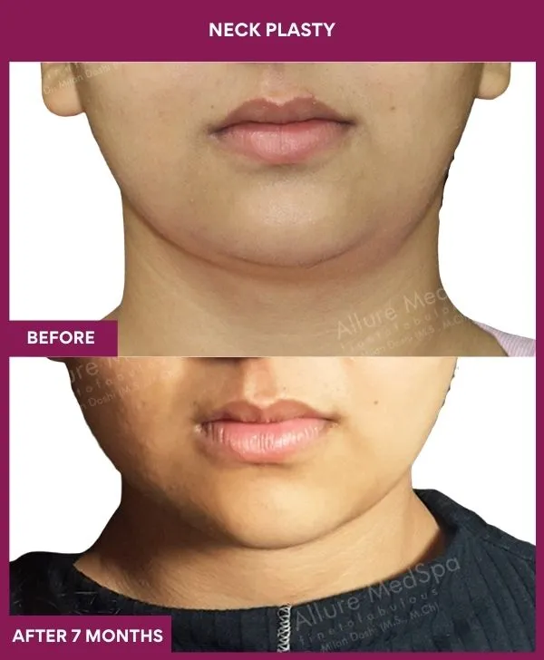 neck-lift-surgery-before-after-results-mumbai-india-patient01-front