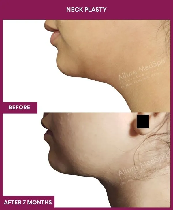 neck-lift-surgery-before-after-results-mumbai-india-patient01-side-left