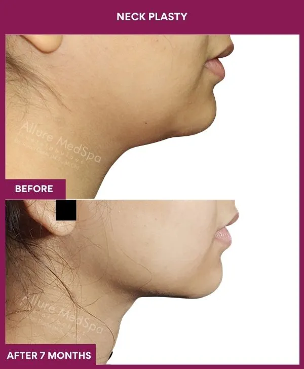 neck-lift-surgery-before-after-results-mumbai-india-patient01-side-right
