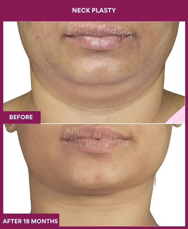 neck-lift-surgery-before-after-results-mumbai-india-patient02-front