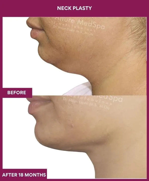 neck-lift-surgery-before-after-results-mumbai-india-patient02-side-left